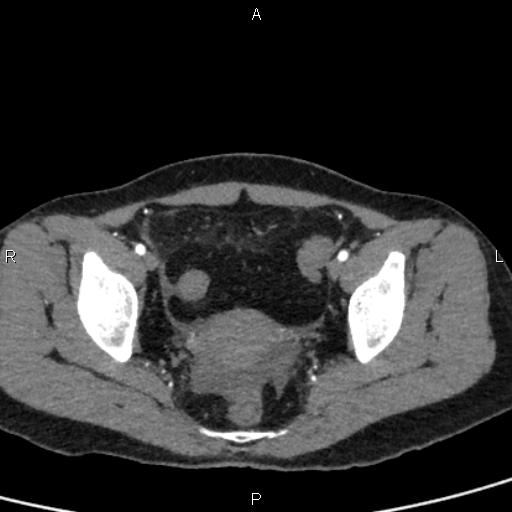 Bilateral adrenal gland hyperenhancement in pancreatitis (Radiopaedia 86642-102753 B 113).jpg