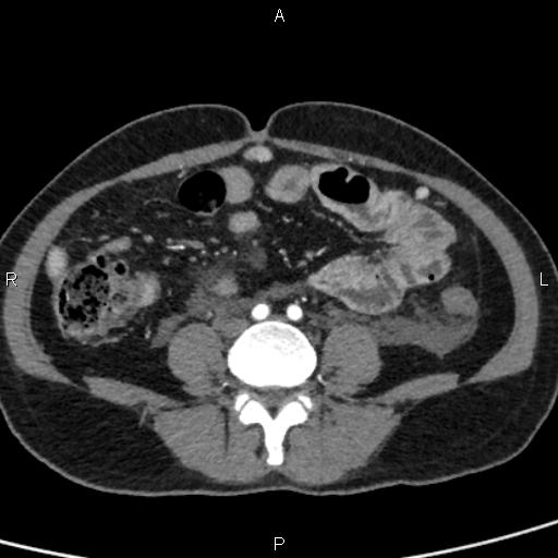 Bilateral adrenal gland hyperenhancement in pancreatitis (Radiopaedia 86642-102753 B 87).jpg