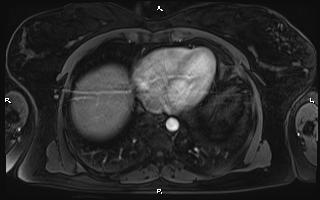Bilateral adrenal myelolipoma (Radiopaedia 63058-71537 Axial T1 C+ fat sat 9).jpg