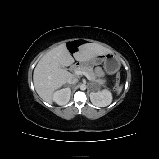 Bilateral adrenal thrombosis (Radiopaedia 58182-65256 A 21).jpg