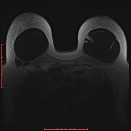 File:Bilateral breast implant rupture (Radiopaedia 24761-25027 PASTA 15).jpg