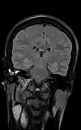File:Bilateral carotid body tumors and right jugular paraganglioma (Radiopaedia 20024-20060 Coronal 52).jpg