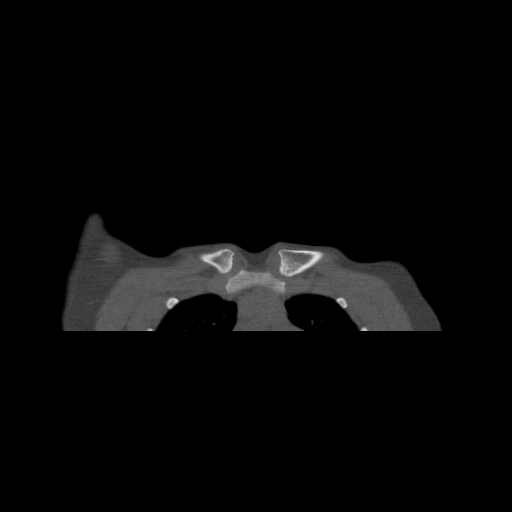 Bilateral chronic posterior shoulder dislocation (Radiopaedia 39213-41452 Coronal bone window 4).jpg