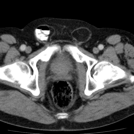 File:Bilateral direct inguinal herniae (Radiopaedia 17016-16719 B 21).jpg