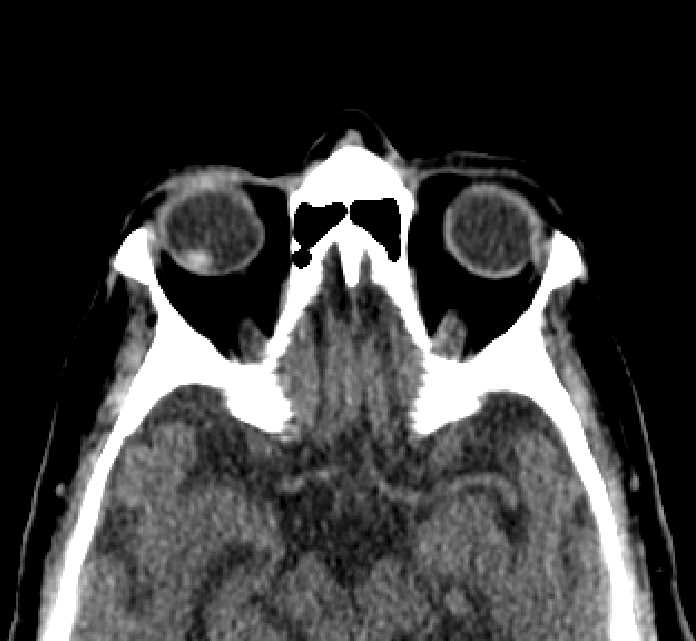 Bilateral ectopia lentis (Radiopaedia 89889-107013 Axial non-contrast 26).jpg
