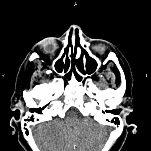 Bilateral enlargement of lacrimal glands - sarcoidosis (Radiopaedia 62627-70921 Axial non-contrast 26).jpg
