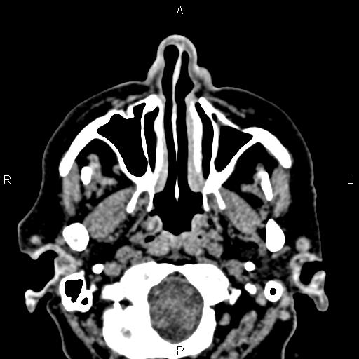 File:Bilateral enlargement of lacrimal glands - sarcoidosis (Radiopaedia 62627-70921 Axial non-contrast 5).jpg