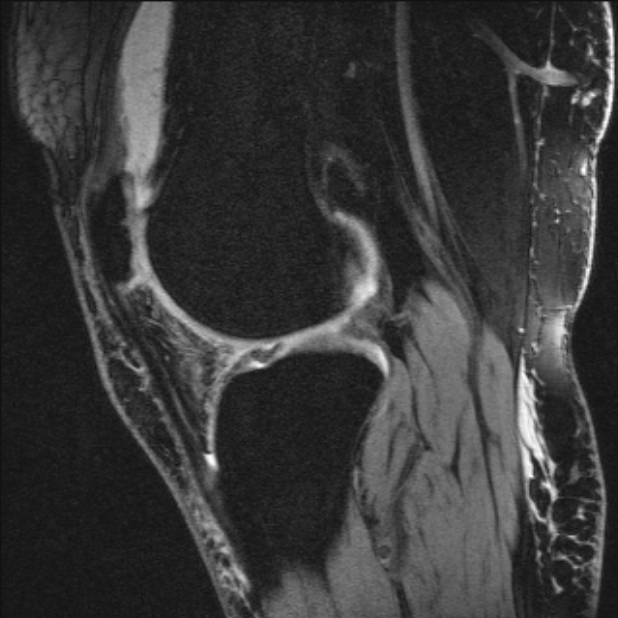 Bilateral focal pigmented villonodular synovitis (Radiopaedia 67643-77073 Sagittal T1 vibe 26).jpg