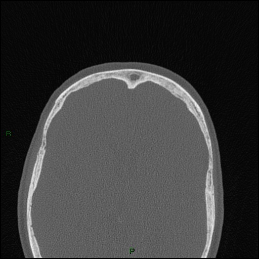 Bilateral frontal mucoceles (Radiopaedia 82352-96454 Axial bone window 66).jpg