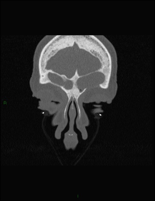Bilateral frontal mucoceles (Radiopaedia 82352-96454 Coronal 60).jpg