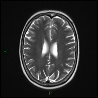 File:Bilateral frontal mucoceles (Radiopaedia 82352-96455 Axial T2 14).jpg