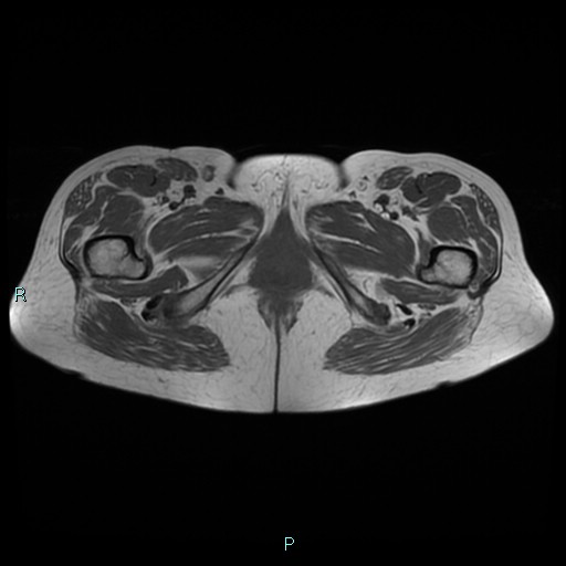 File:Bilateral ovarian fibroma (Radiopaedia 44568-48293 Axial T1 31).jpg