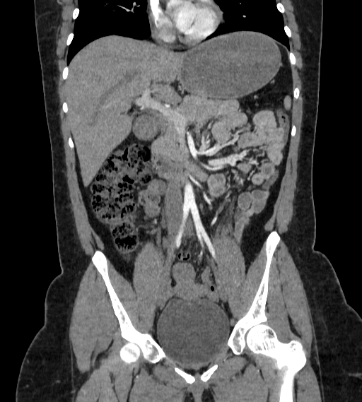 Bilateral ovarian mature cystic teratomas (Radiopaedia 79373-92457 B 27).jpg