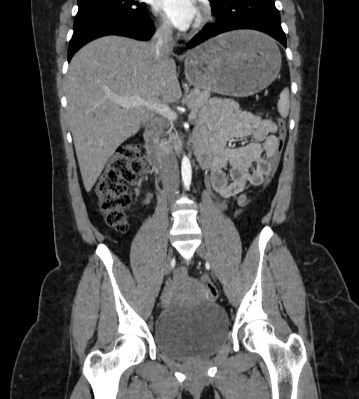 File:Bilateral ovarian mature cystic teratomas (Radiopaedia 79373-92457 B 34).jpg