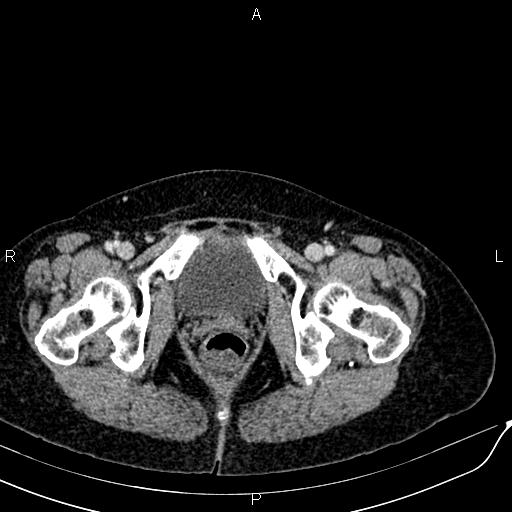 Bilateral ovarian serous cystadenocarcinoma (Radiopaedia 86062-101989 B 101).jpg