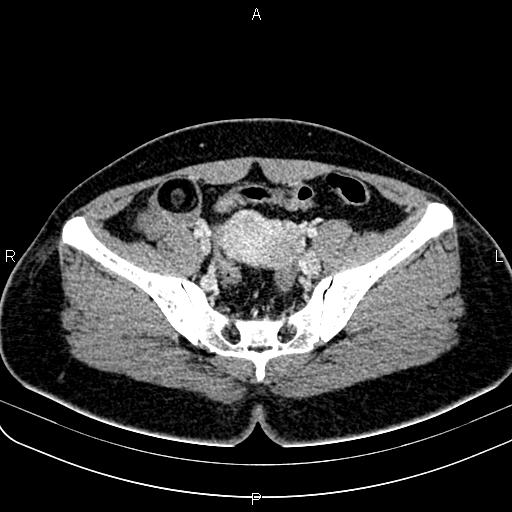 Bilateral ovarian teratoma (Radiopaedia 83131-97503 Axial With contrast 32).jpg