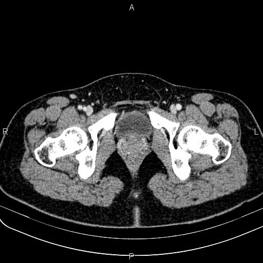 Bilateral ovarian teratoma (Radiopaedia 83131-97503 Axial With contrast 76).jpg