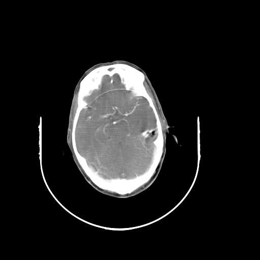 Bilateral parotid gland lymphoma (Radiopaedia 21038-20969 A 1).jpg
