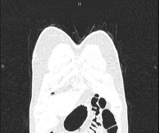 Bilateral pulmonary AVM (Radiopaedia 83134-97505 Coronal lung window 13).jpg