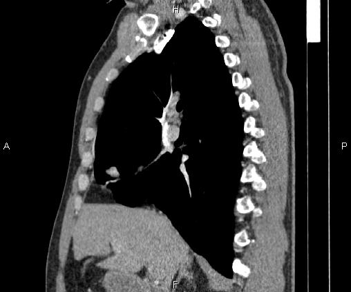 Bilateral pulmonary AVM (Radiopaedia 83134-97505 D 50).jpg