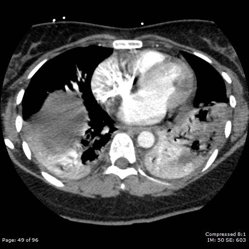 File:Bilateral pulmonary emboli with Hampton hump sign (Radiopaedia 54070-60246 Axial C+ CTPA 46).jpg