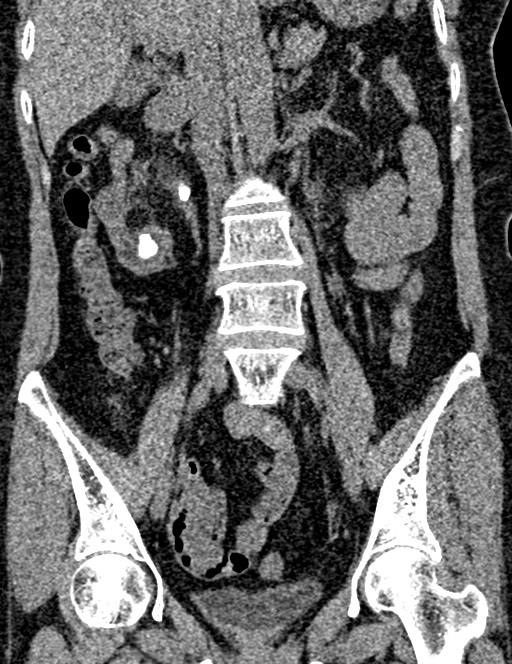 Bilateral staghorn calculi (Radiopaedia 59475-66842 Coronal non-contrast 59).jpg