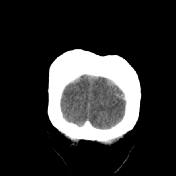 Bilateral subdural hemorrhages (Radiopaedia 26588-26732 Coronal non-contrast 57).jpg
