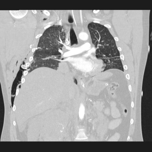 Bilateral traumatic renovascular injury (Radiopaedia 32051-32995 Coronal lung window 43).jpg