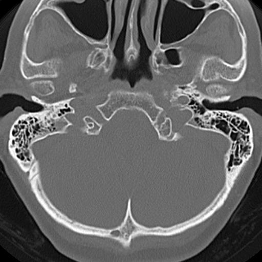 File:Bilateral tympanoplasty (Radiopaedia 16947-16664 Axial bone window 22).jpg