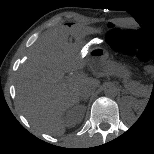 Bile leak from liver traumatic laceration (Radiopaedia 63463-72077 Axial Biliscopin 37).jpg