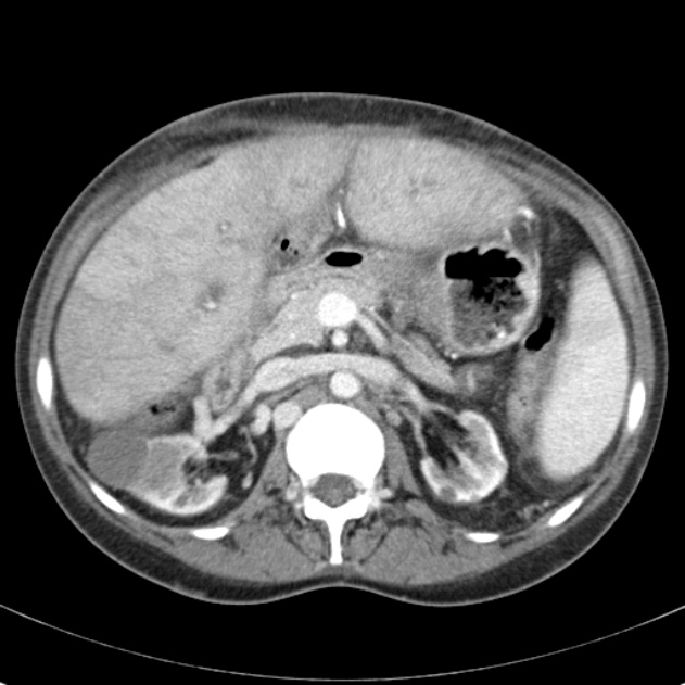 Biliary necrosis - liver transplant (Radiopaedia 21876-21846 B 28).jpg