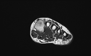 Bipartite hallux sesamoid diastasis (Radiopaedia 77133-89109 Coronal PD 11).jpg