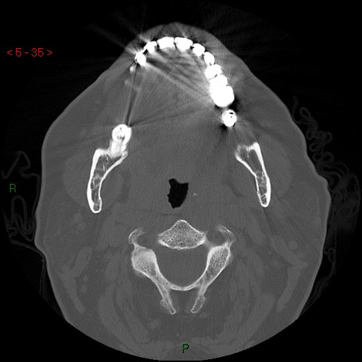 File:Bisphosphonate-related osteonecrosis of the jaw (Radiopaedia 54147-60329 Axial bone window 29).jpg