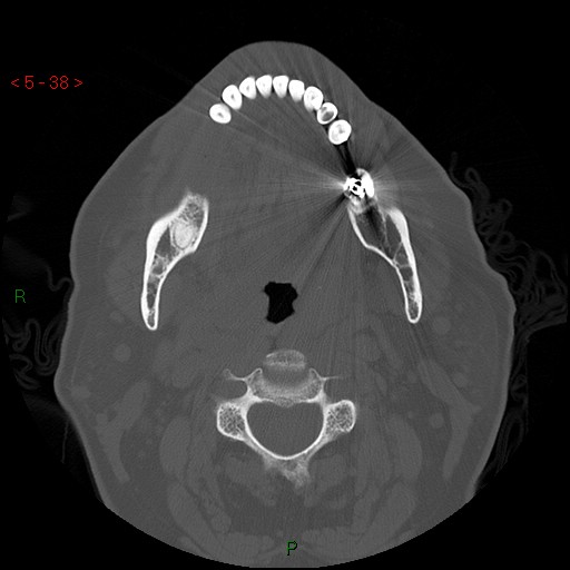 File:Bisphosphonate-related osteonecrosis of the jaw (Radiopaedia 54147-60329 Axial bone window 32).jpg