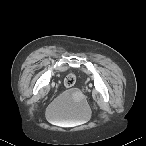 File:Bladder papillary urothelial carcinoma (Radiopaedia 48119-52951 Axial C+ delayed 49).png