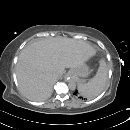 Bladder rupture post renal biopsy (Radiopaedia 30863-31572 Axial non-contrast 14).jpg