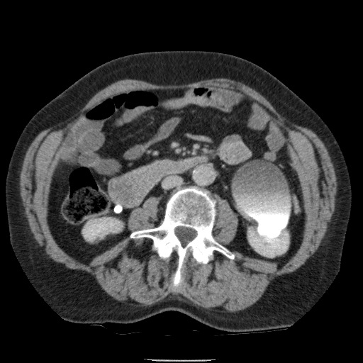 Bladder tumor detected on trauma CT (Radiopaedia 51809-57609 C 68).jpg