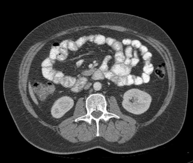 File:Bleeding duodenal ulcer and adenomyomatosis of gallbladder (Radiopaedia 61834-69861 A 59).jpg