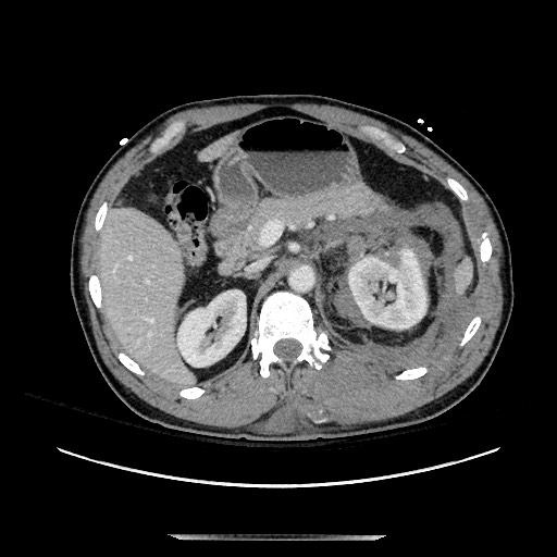 Blunt abdominal trauma with solid organ and musculoskelatal injury with active extravasation (Radiopaedia 68364-77895 A 44).jpg