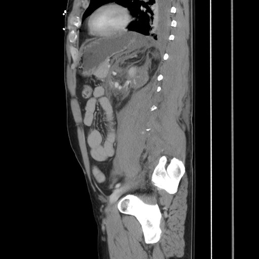File:Blunt abdominal trauma with solid organ and musculoskelatal injury with active extravasation (Radiopaedia 68364-77895 C 96).jpg