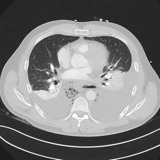 Boerhaave syndrome (Radiopaedia 39382-41660 Axial lung window 31).png