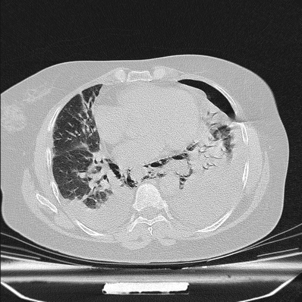 Boerhaave syndrome (Radiopaedia 45644-49799 Axial lung window 75).jpg