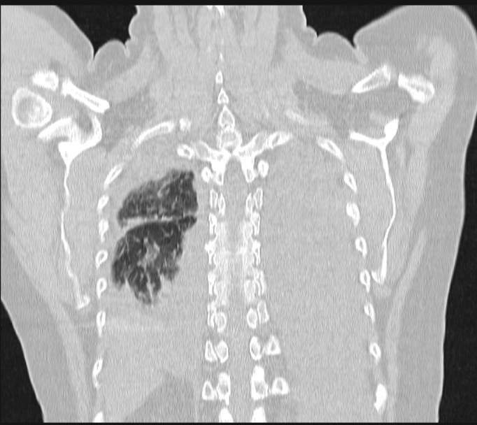 Boerhaave syndrome (Radiopaedia 45644-49799 Coronal lung window 56).jpg