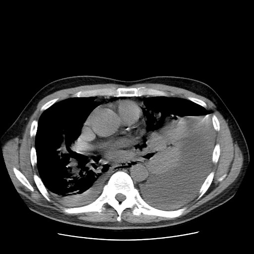 File:Boerhaave syndrome (Radiopaedia 59796-67310 Axial liver window 34).jpg