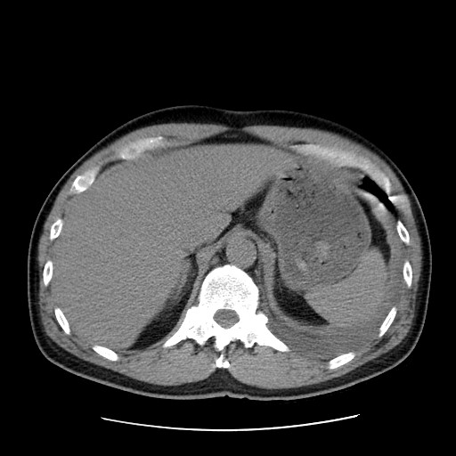 Boerhaave syndrome (Radiopaedia 59796-67310 Axial liver window 59).jpg