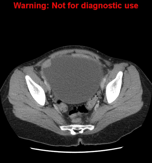 Borderline mucinous cystadenoma of ovary (Radiopaedia 25586-25767 A 96).jpg