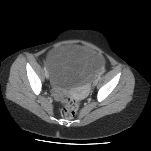 File:Borderline mucinous tumor (ovary) (Radiopaedia 78228-90808 A 125).jpg