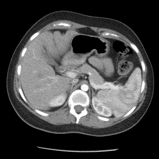 File:Borderline mucinous tumor (ovary) (Radiopaedia 78228-90808 A 46).jpg