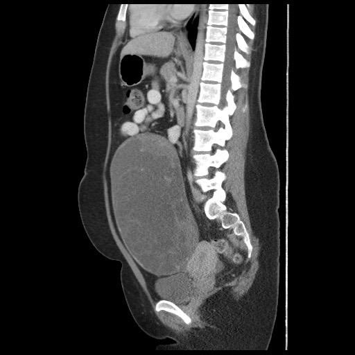 File:Borderline mucinous tumor (ovary) (Radiopaedia 78228-90808 B 38).jpg