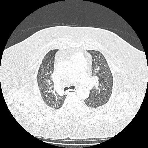 Bovine aortic arch - right internal mammary vein drains into the superior vena cava (Radiopaedia 63296-71875 Axial lung window 54).jpg